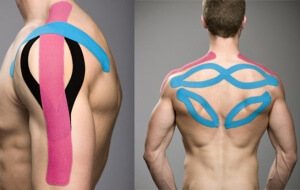 Кинезиотейпирование